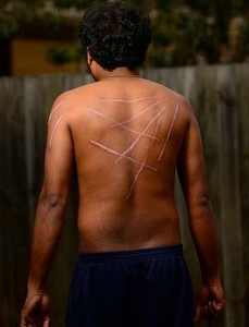 Tamil aslyum seeker 'Kumar' shows his wounds.