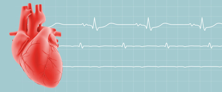 Nearly 40% of deaths at Badulla Hospital due to heart failures & to the absence of an angiogram machine – GMOA